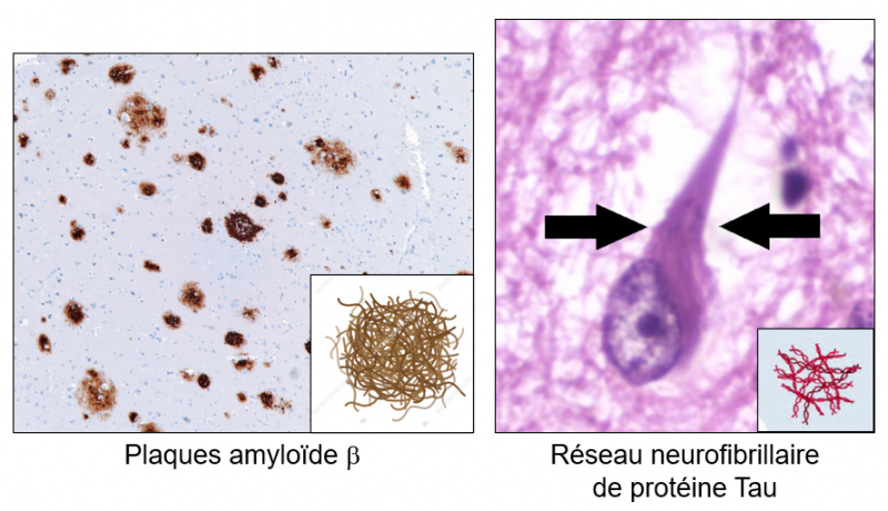 Plaques amyloide et reseaux fibrillaire tau