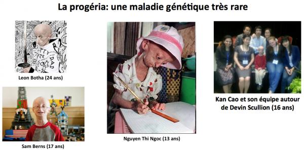 Progeria 1